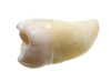 wisdom tooth - photo/picture definition - wisdom tooth word and phrase image