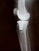 knee replacement - photo/picture definition - knee replacement word and phrase image