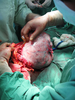 ovarian tumor surgery - photo/picture definition - ovarian tumor surgery word and phrase image