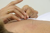 acupuncture - photo/picture definition - acupuncture word and phrase image